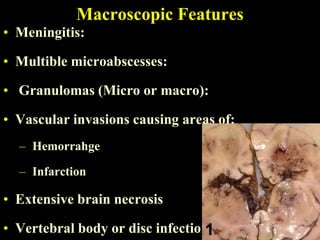 Macroscopic Features
• Meningitis:

• Multible microabscesses:

• Granulomas (Micro or macro):

• Vascular invasions causing areas of:
  – Hemorrahge

  – Infarction

• Extensive brain necrosis

• Vertebral body or disc infection
 