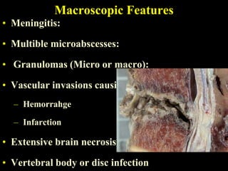 Macroscopic Features
• Meningitis:

• Multible microabscesses:

• Granulomas (Micro or macro):

• Vascular invasions causing areas of:
  – Hemorrahge

  – Infarction

• Extensive brain necrosis

• Vertebral body or disc infection
 