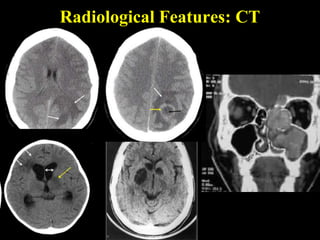 Radiological Features: CT
 