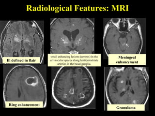 Radiological Features: MRI




                       small enhancing lesions (arrows) in the      Meningeal
Ill defined in flair   erivascular spaces along lenticulostriate
                                                                   enhancement
                             arteries in the basal ganglia.




 Ring enhancement
                                                                   Granuloma
 