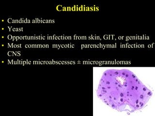 Candidiasis
• Candida albicans
• Yeast
• Opportunistic infection from skin, GIT, or genitalia
• Most common mycotic parenchymal infection of
  CNS
• Multiple microabscesses ± microgranulomas
 