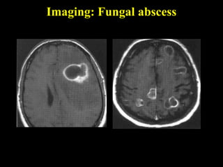 Imaging: Fungal abscess
 