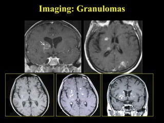 Imaging: Granulomas
 