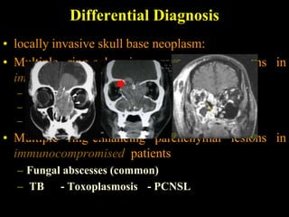 Differential Diagnosis
• locally invasive skull base neoplasm:
• Multiple ring-enhancing parenchymal lesions in
  immunocompetent patients:
  – Metastases    - Multiple pyogenic abscesses
  – TB     - Parasites (e.g., neurocysticercosis)
  – Fungal abscess (rare)        - Septic emboli
• Multiple ring-enhancing parenchymal lesions in
  immunocompromised patients
  – Fungal abscesses (common)
  – TB - Toxoplasmosis - PCNSL
 