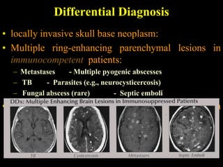 Differential Diagnosis
• locally invasive skull base neoplasm:
• Multiple ring-enhancing parenchymal lesions in
  immunocompetent patients:
  – Metastases    - Multiple pyogenic abscesses
  – TB     - Parasites (e.g., neurocysticercosis)
  – Fungal abscess (rare)        - Septic emboli
• Multiple ring-enhancing parenchymal lesions in
  immunocompromised patients
  – Fungal abscesses (common)
  – TB - Toxoplasmosis - PCNSL
 