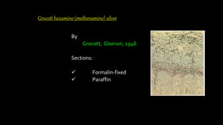 Grocott hexamine (methenamine) silver
By
Grocott, Glomori, 1946
Sections:
 Formalin-fixed
 Paraffin
 