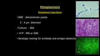 Histoplasmosis
Histoplasma Capsulatum
• DME – demonstrate yeasts
2 - 4 µm diameter
• Culture - SDA
• H/P - PAS or GMS
• Serologic testing for antibody and antigen detection
 