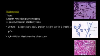 Blastomycosis
Types
1.North American Blastomycosis
2. South American Blastomycosis
• Culture - Sabouraud’s agar, growth is slow up to 6 weeks at
32°c.
• H/P - PAS or Methanamine silver stain
 