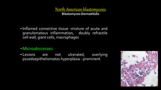 North American blastomycosis
Blastomyces Dermatitidis
• Inflamed connective tissue -mixture of acute and
granulomatous inflammation, doubly refractile
cell wall, giant cells, macrophages
•Microabscesses
• Lesions are not ulcerated, overlying
psuedoepitheliomatos hyperplasia - prominent
 