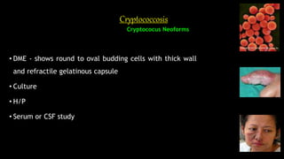 Cryptococcosis
Cryptococus Neoforms
• DME - shows round to oval budding cells with thick wall
and refractile gelatinous capsule
• Culture
• H/P
• Serum or CSF study
 