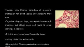 Necrosis with thrombi consisting of organism,
predilection for blood vessels and penetrate their
walls
Organism - 6-30µm, large, non septate hyphae with
branching out obtuse angle and round to ovoid
sporangia is also seen
This distrupts normal blood flow to the tissue,
resulting - infarction and necrosis
 Neutrophilic infiltrate - predominates in the viable
 