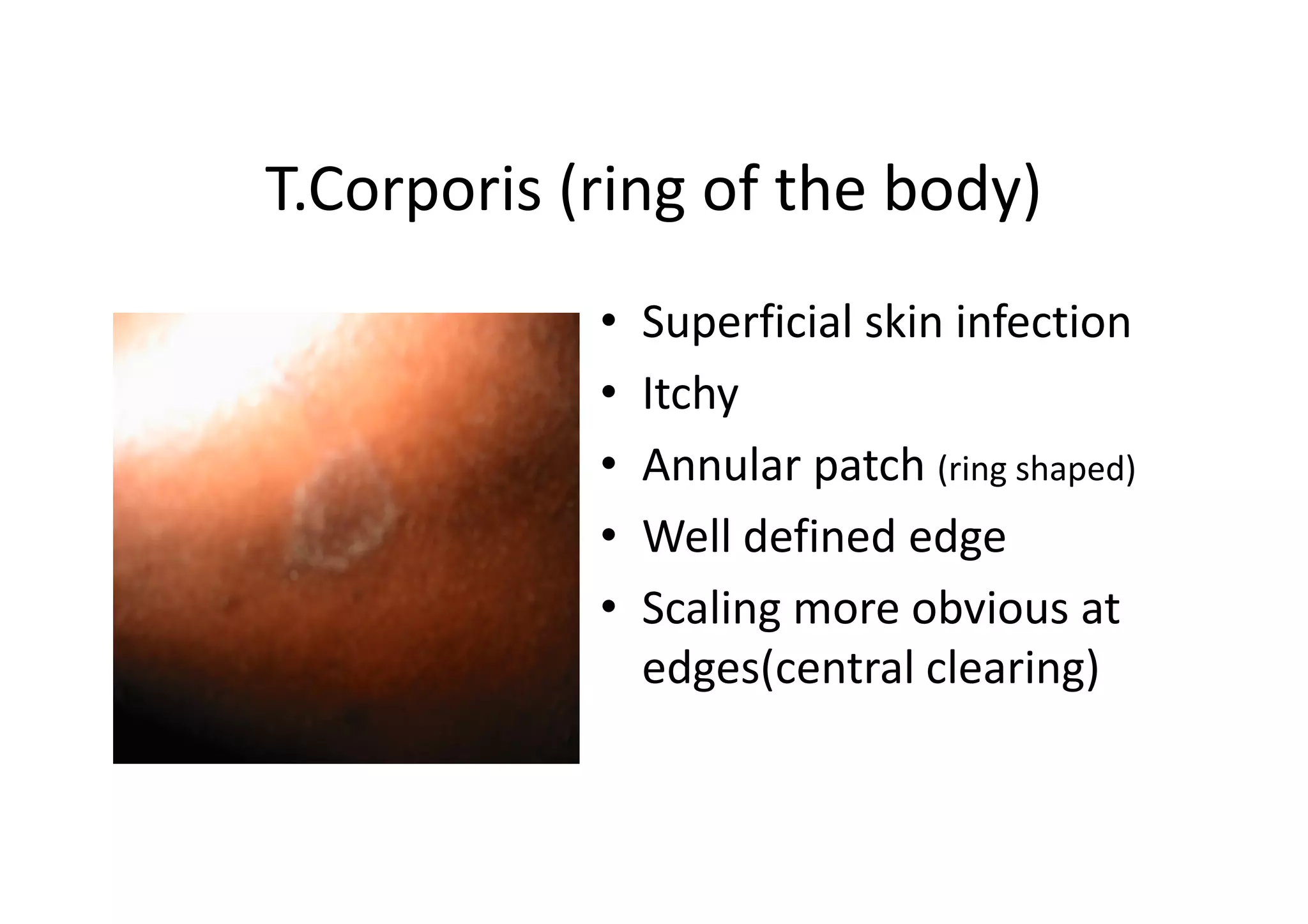 T.Corporis (ring of the body)
            •   Superficial skin infection
            •   Itchy
            •   Annular patch (ring shaped)
            •   Well defined edge
            •   Scaling more obvious at
                edges(central clearing)
 