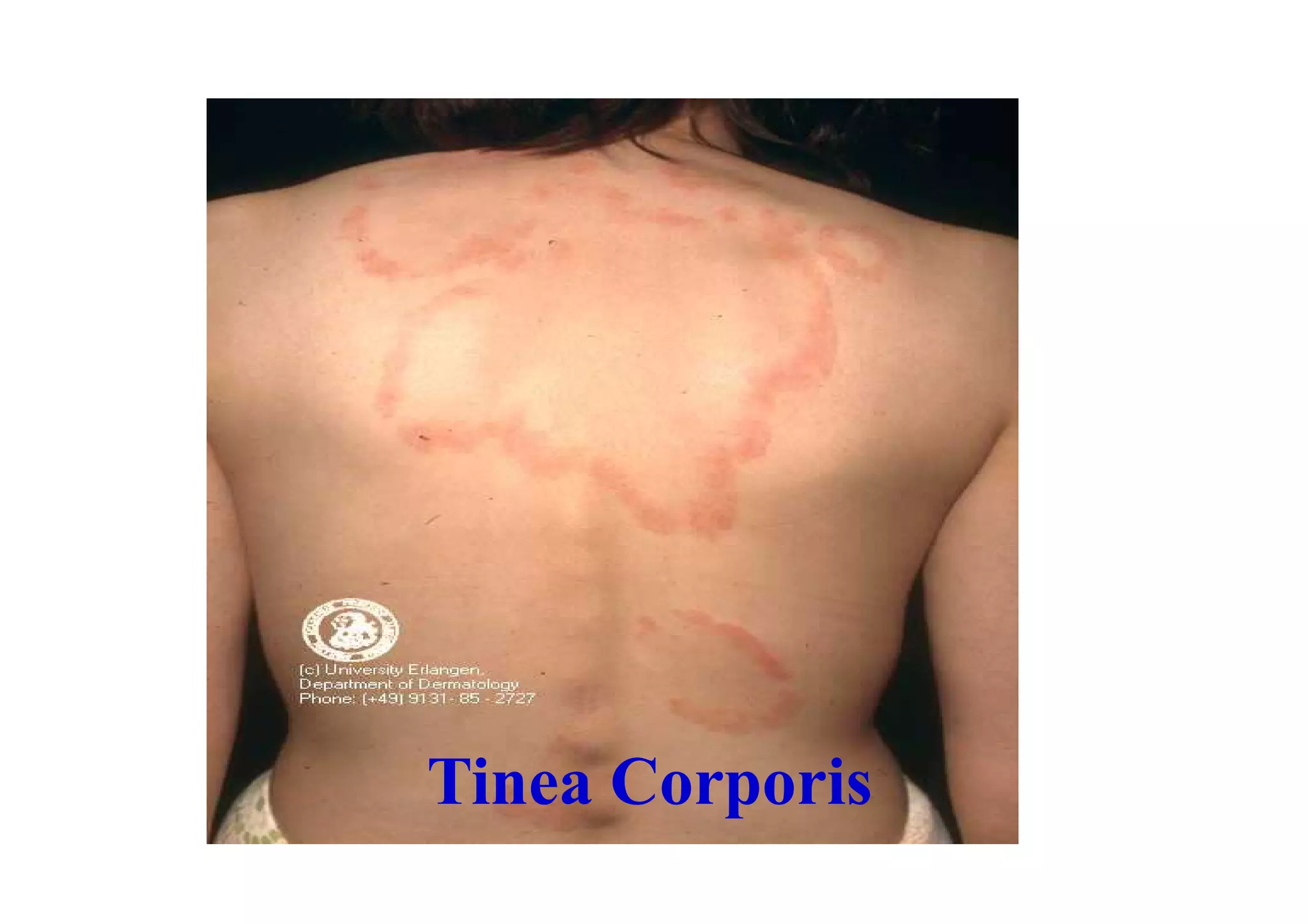 Tinea Corporis
 