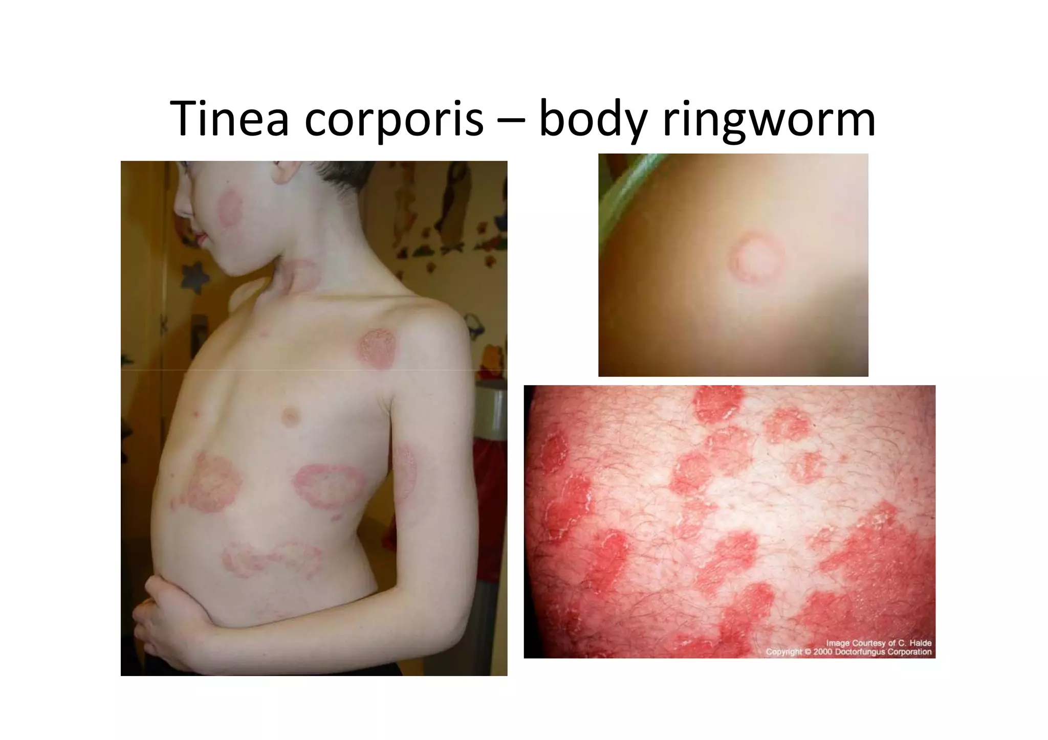 Tinea corporis – body ringworm
 