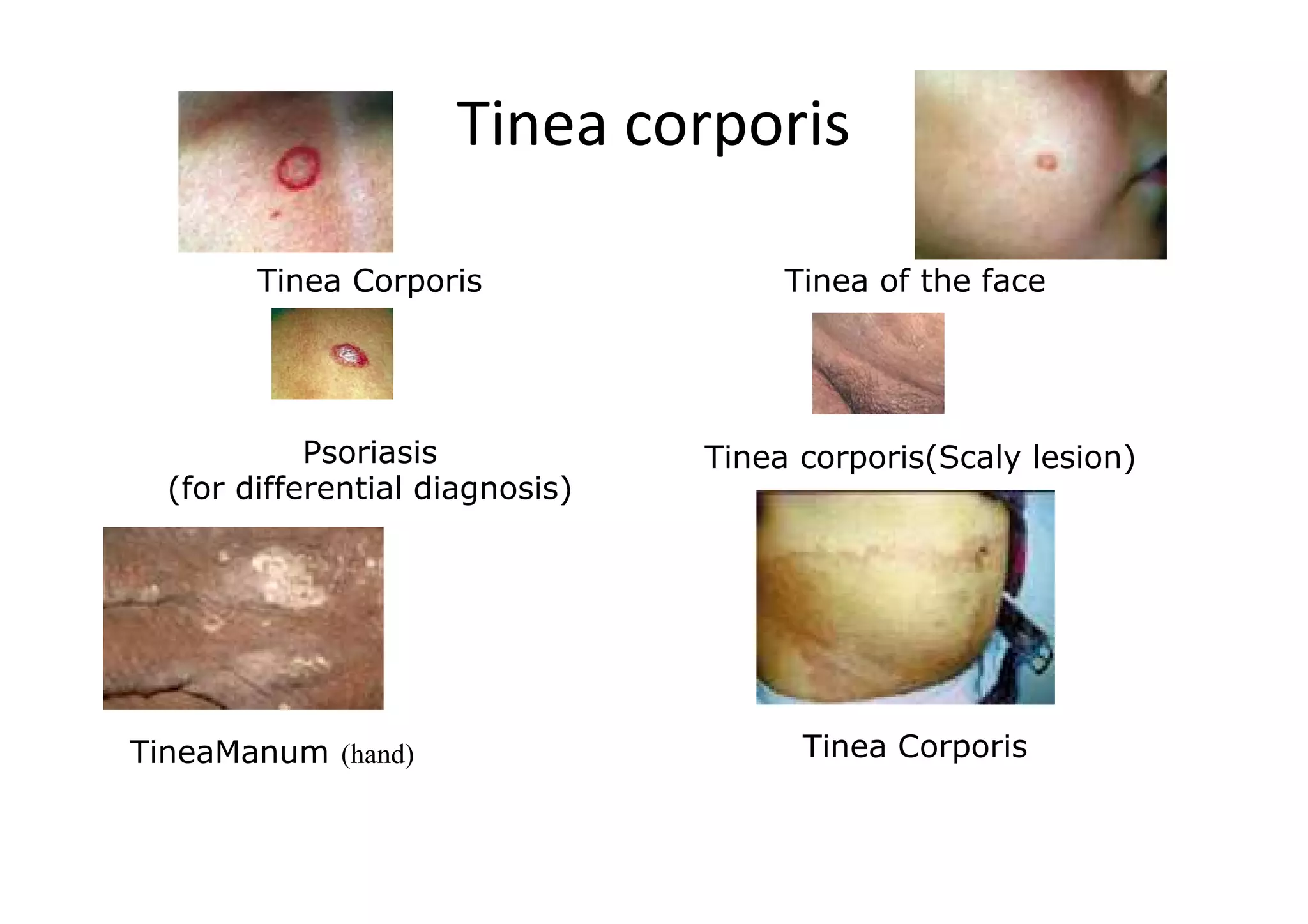 Tinea corporis

        Tinea Corporis                Tinea of the face




            Psoriasis            Tinea corporis(Scaly lesion)
  (for differential diagnosis)




TineaManum (hand)                      Tinea Corporis
 