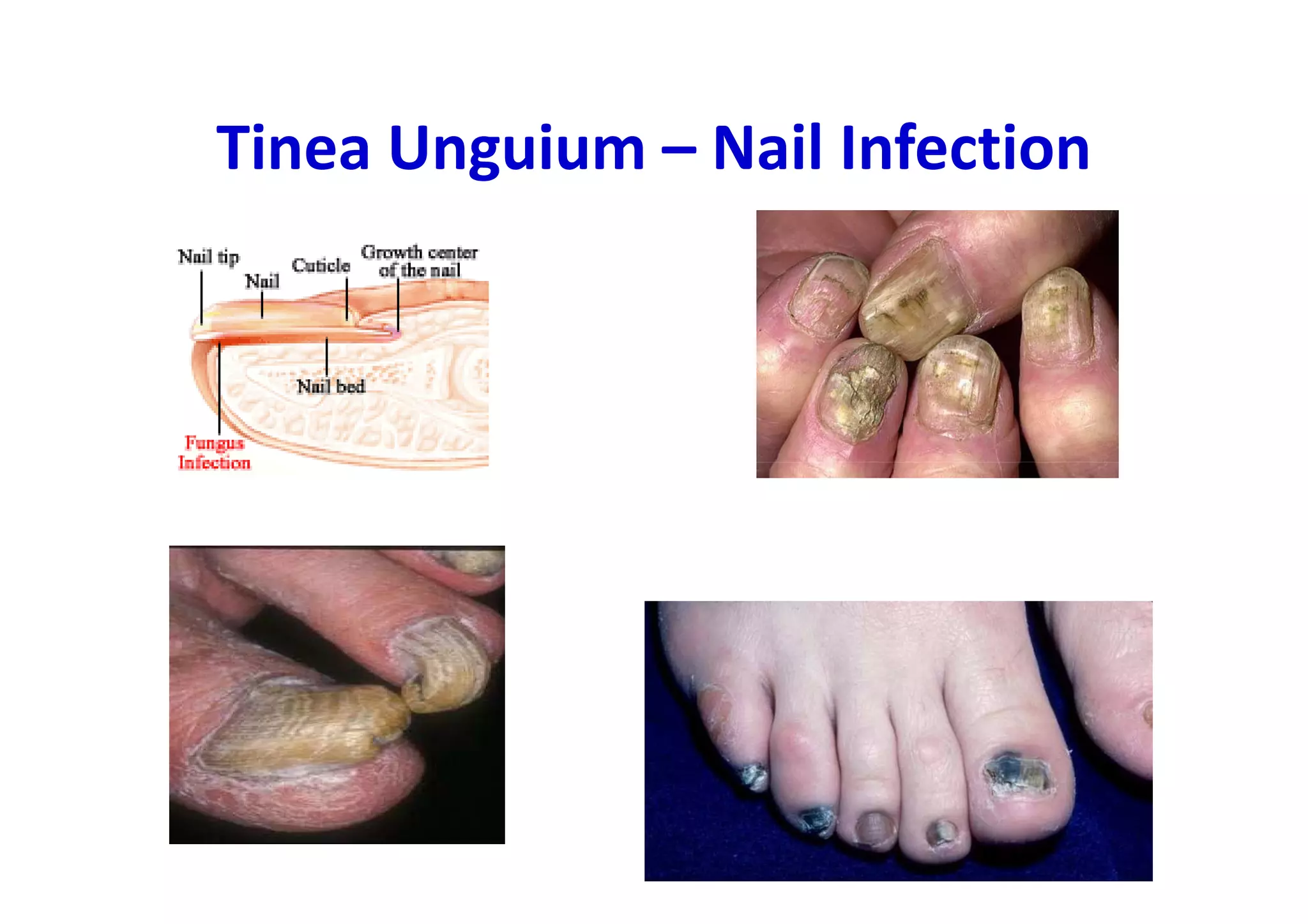 Tinea Unguium – Nail Infection
 
