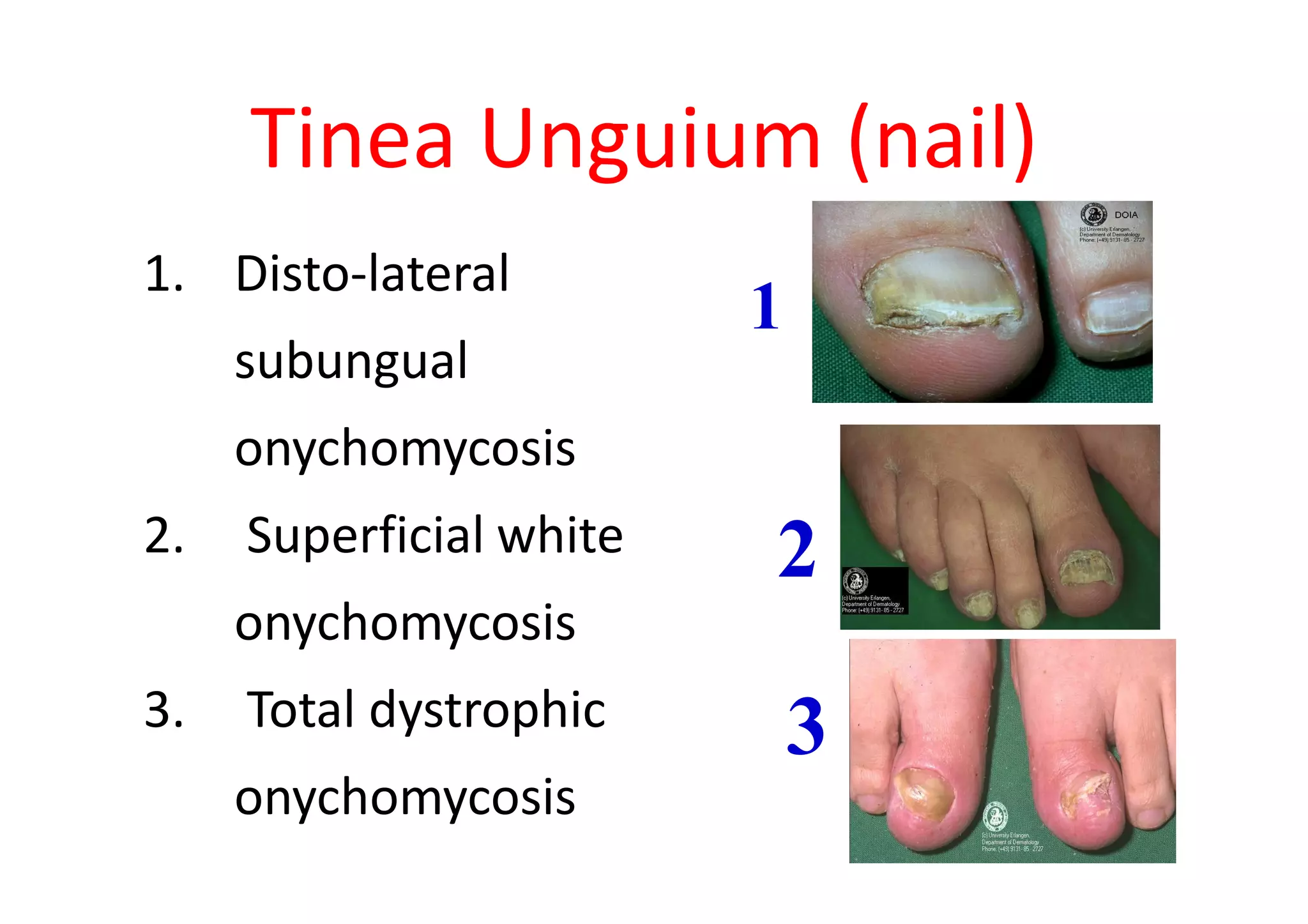 Tinea Unguium (nail)
1. Disto-lateral
                         1
     subungual
     onychomycosis
2.   Superficial white   2
     onychomycosis
3.   Total dystrophic        3
     onychomycosis
 