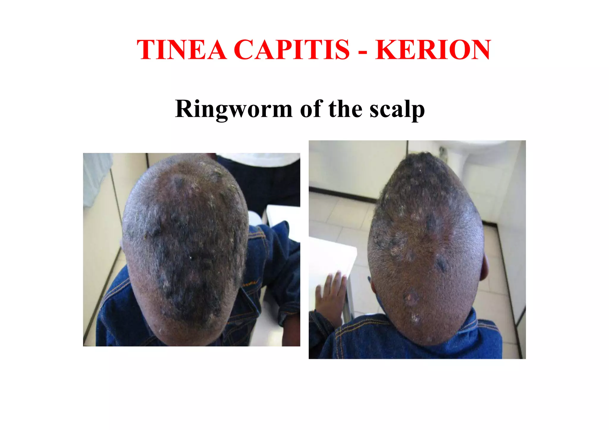 TINEA CAPITIS - KERION

  Ringworm of the scalp
 