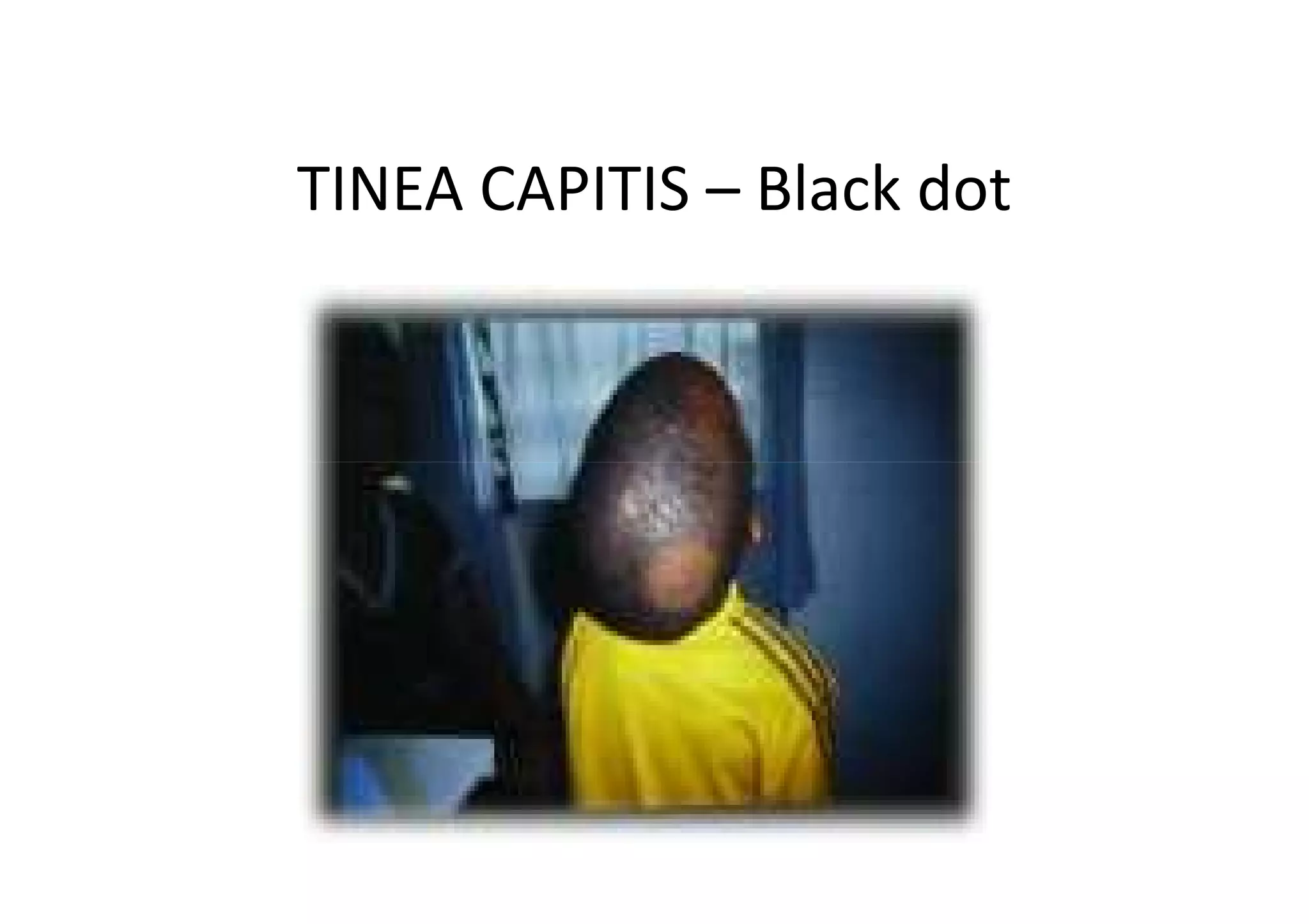 TINEA CAPITIS – Black dot
 