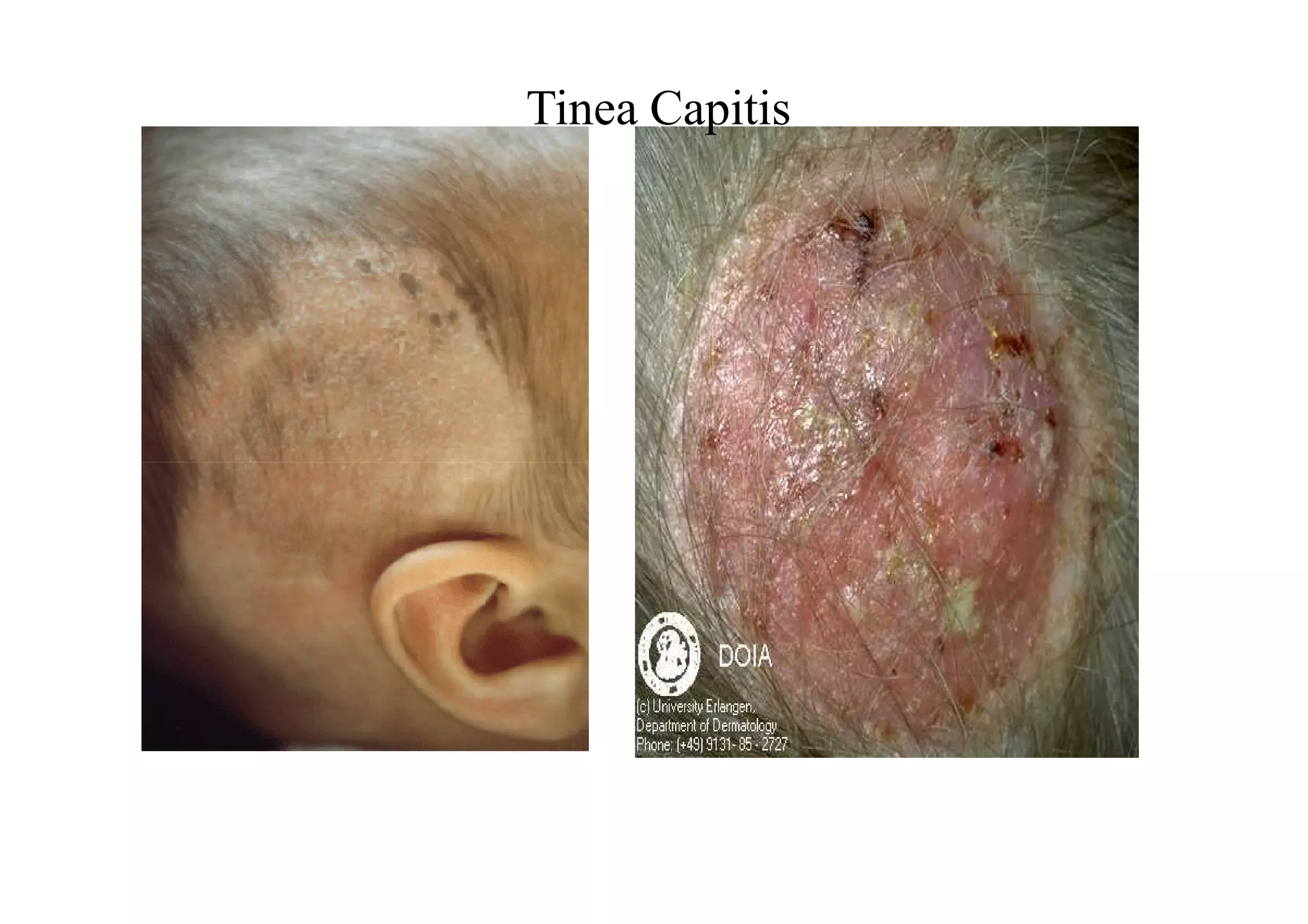 Tinea Capitis
 