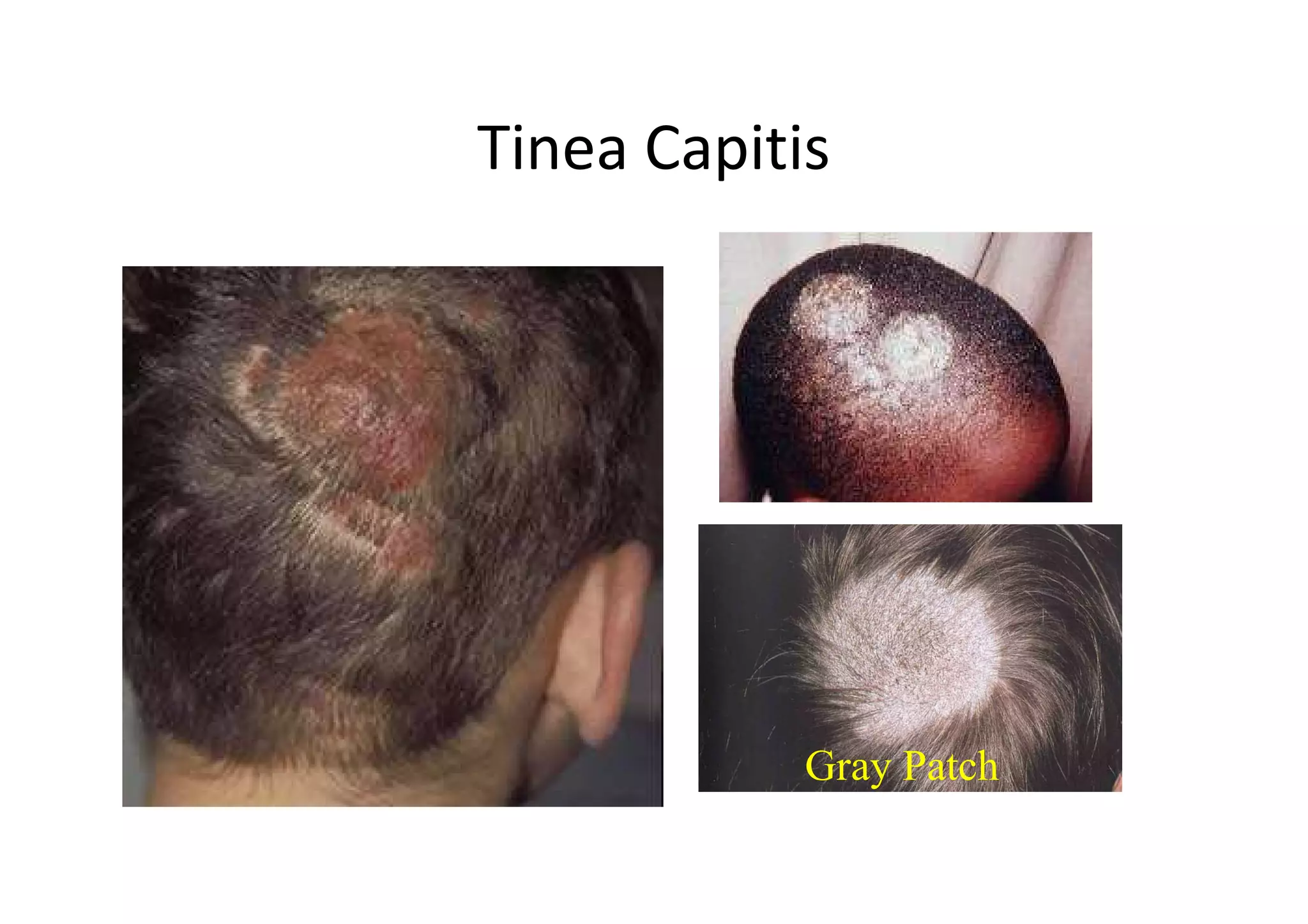 Tinea Capitis




            Gray Patch
 
