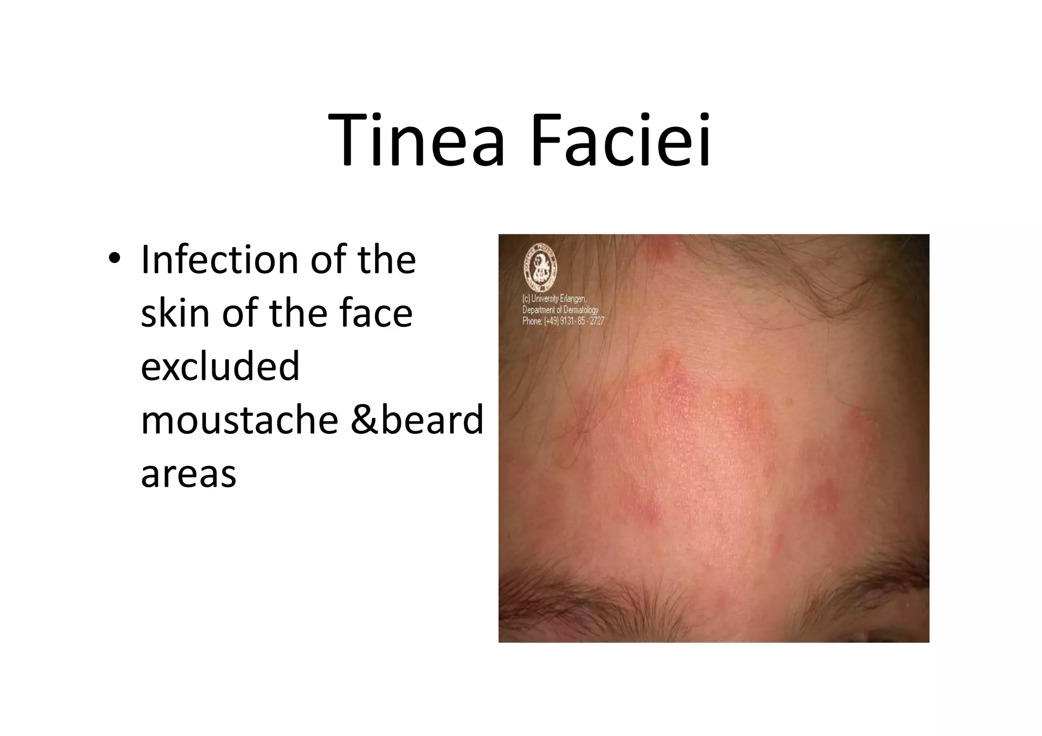 Tinea Faciei
• Infection of the
  skin of the face
  excluded
  moustache &beard
  areas
 
