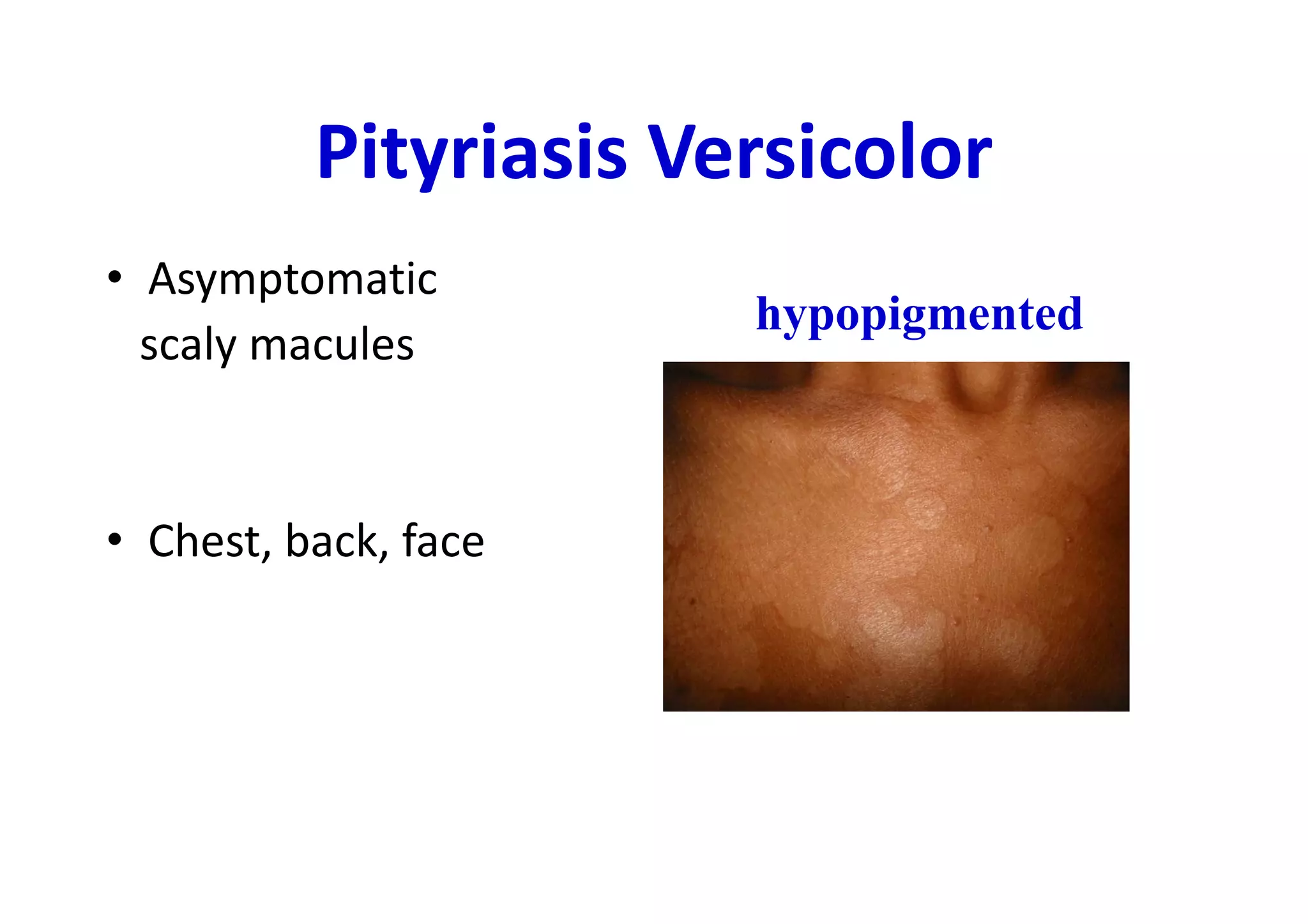 Pityriasis Versicolor
• Asymptomatic
                       hypopigmented
  scaly macules


• Chest, back, face
 