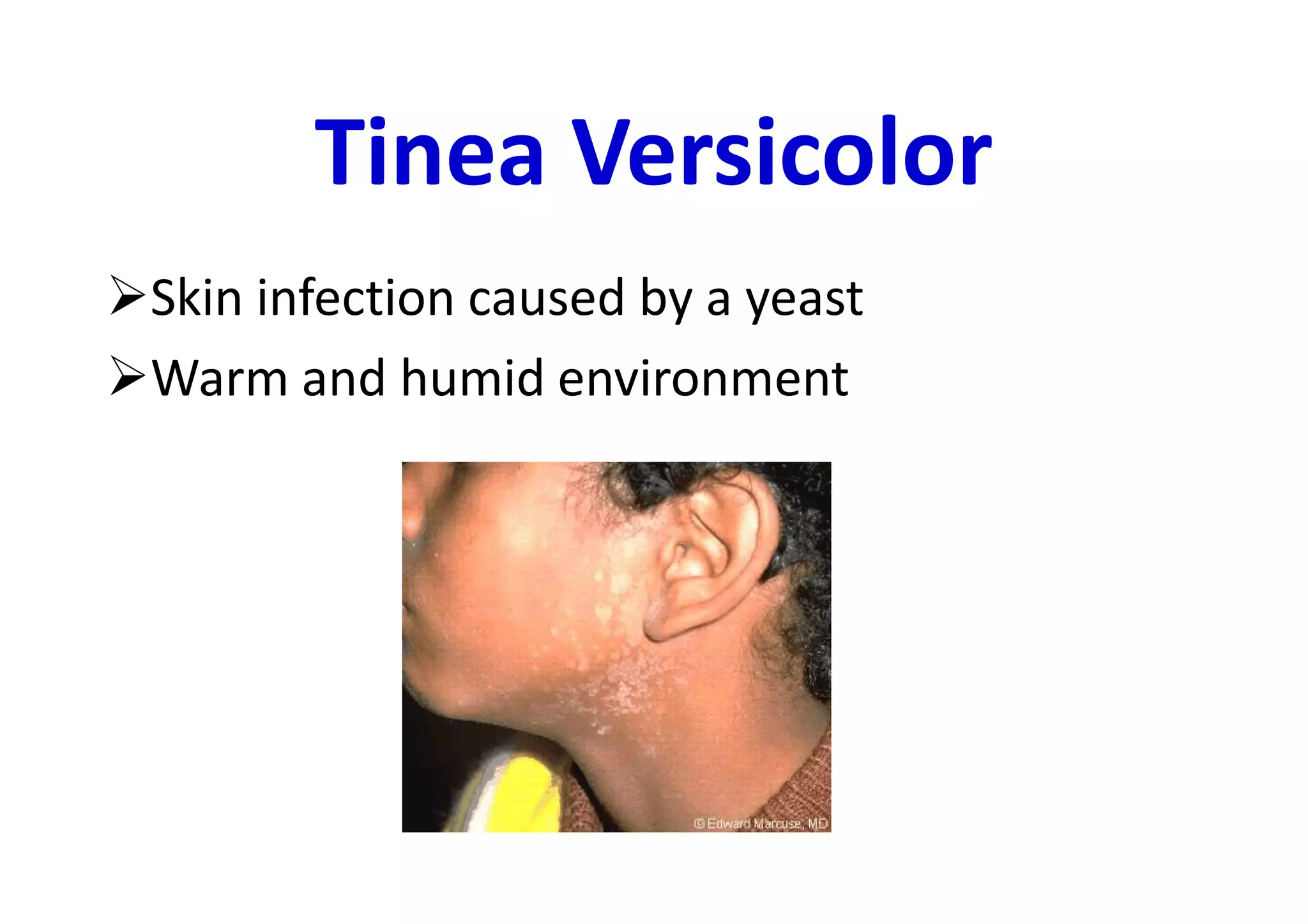 Tinea Versicolor
Skin infection caused by a yeast
Warm and humid environment
 