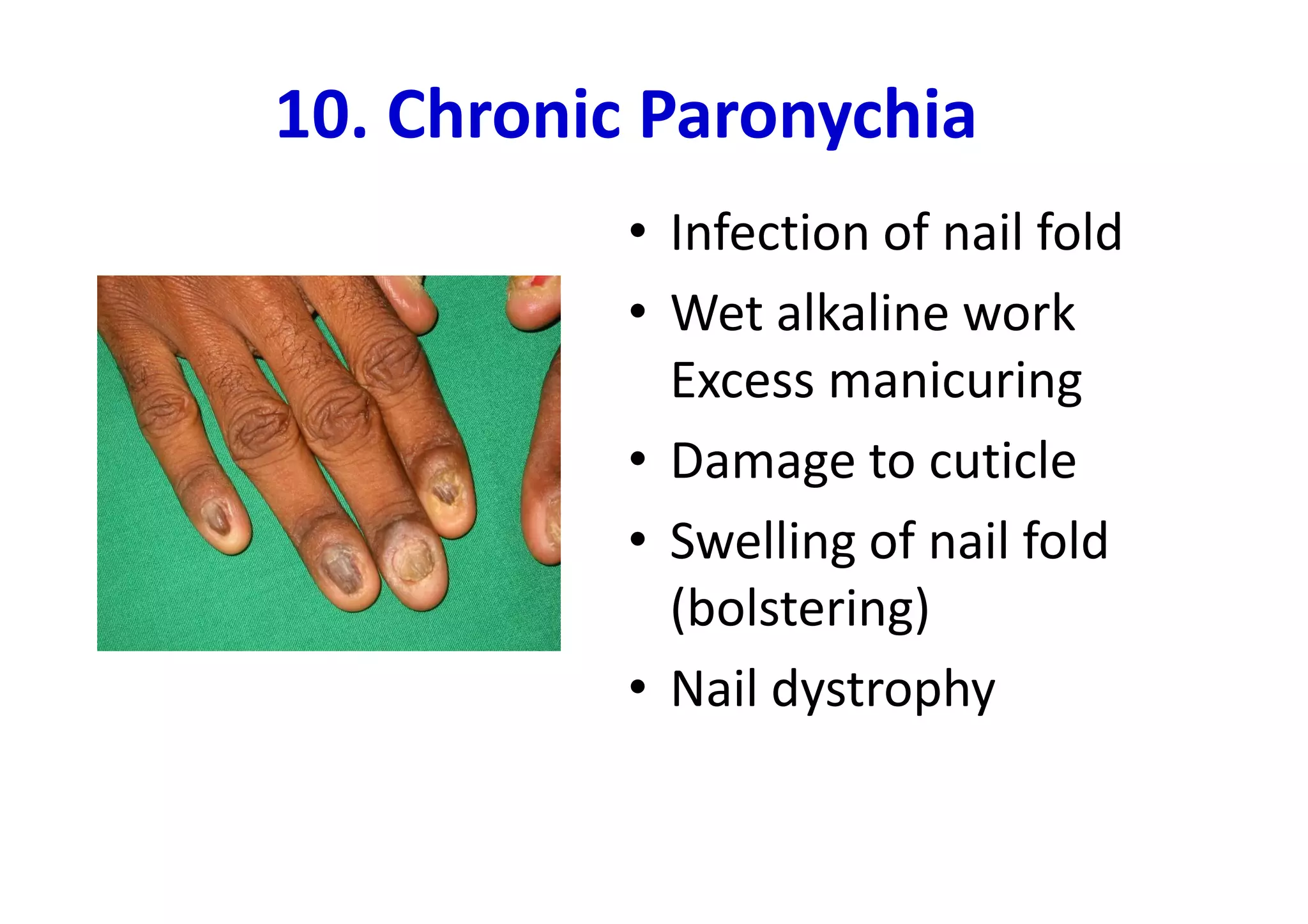 10. Chronic Paronychia
           • Infection of nail fold
           • Wet alkaline work
             Excess manicuring
           • Damage to cuticle
           • Swelling of nail fold
             (bolstering)
           • Nail dystrophy
 