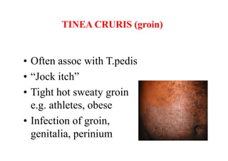 Fungal infections of skin [compatibility mode] | PDF