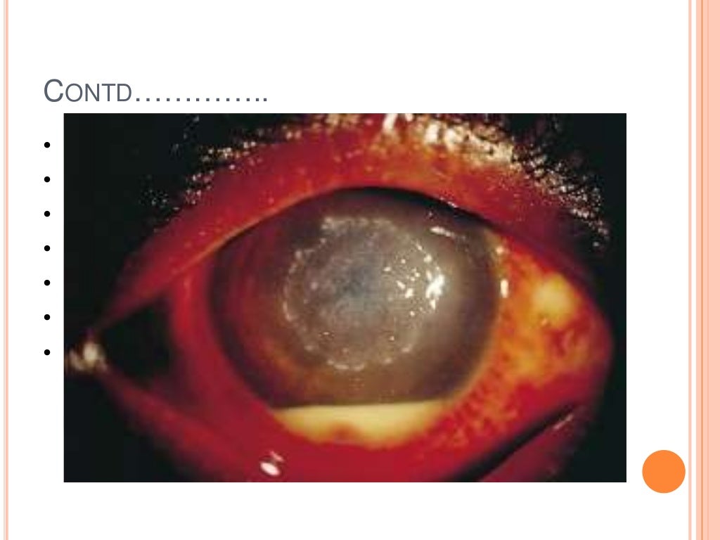 Fungal infections of the eye