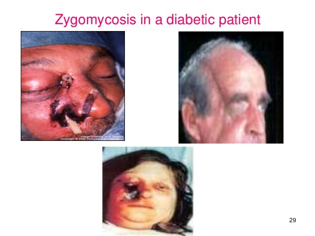 Fungal infections of the oral cavity