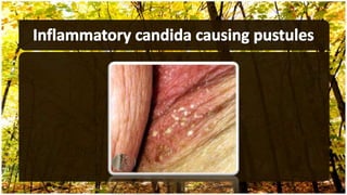 Fungal infections part II | PPTX