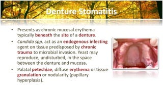• Presents as chronic mucosal erythema 
typically beneath the site of a denture. 
• Candida spp. act as an endogenous infecting 
agent on tissue predisposed by chronic 
trauma to microbial invasion. Yeast may 
reproduce, undisturbed, in the space 
between the denture and mucosa. 
• Palatal petechiae, diffuse erythema or tissue 
granulation or nodularity (papillary 
hyperplasia). 
 