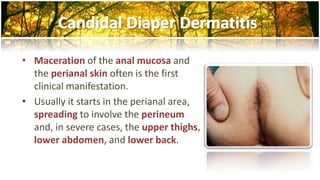 • Maceration of the anal mucosa and 
the perianal skin often is the first 
clinical manifestation. 
• Usually it starts in the perianal area, 
spreading to involve the perineum 
and, in severe cases, the upper thighs, 
lower abdomen, and lower back. 
 