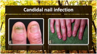 Fungal infections part II