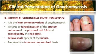 3. PROXIMAL SUBUNGUAL ONYCHOMYCOSIS: 
• It is the least common variant of onychomycosis. 
• It starts by fungal invasion of the stratum 
corneum of the proximal nail fold and 
subsequently the nail plate. 
• Yellow spots appear at the lunula. 
• Frequently in immunocompromised hosts. 
 