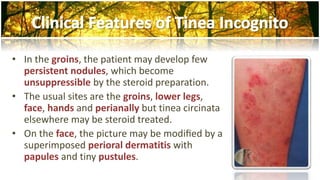 • In the groins, the patient may develop few 
persistent nodules, which become 
unsuppressible by the steroid preparation. 
• The usual sites are the groins, lower legs, 
face, hands and perianally but tinea circinata 
elsewhere may be steroid treated. 
• On the face, the picture may be modified by a 
superimposed perioral dermatitis with 
papules and tiny pustules. 
 