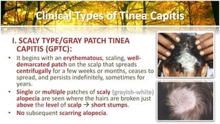 I. SCALY TYPE/GRAY PATCH TINEA 
CAPITIS (GPTC): 
• It begins with an erythematous, scaling, well-demarcated 
patch on the scalp that spreads 
centrifugally for a few weeks or months, ceases to 
spread, and persists indefinitely, sometimes for 
years. 
• Single or multiple patches of scaly (grayish-white) 
alopecia are seen where the hairs are broken just 
above the level of scalp  short stumps. 
• No subsequent scarring alopecia. 
 