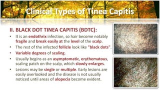II. BLACK DOT TINEA CAPITIS (BDTC): 
• It is an endothrix infection, so hair become notably 
fragile and break easily at the level of the scalp. 
• The rest of the infected follicle look like "black dots". 
• Variable degrees of scaling. 
• Usually begins as an asymptomatic, erythematous, 
scaling patch on the scalp, which slowly enlarges. 
• Lesions may be single or multiple. Early lesions are 
easily overlooked and the disease is not usually 
noticed until areas of alopecia become evident. 
 