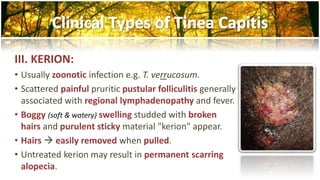 III. KERION: 
• Usually zoonotic infection e.g. T. verrucosum. 
• Scattered painful pruritic pustular folliculitis generally 
associated with regional lymphadenopathy and fever. 
• Boggy (soft & watery) swelling studded with broken 
hairs and purulent sticky material "kerion" appear. 
• Hairs  easily removed when pulled. 
• Untreated kerion may result in permanent scarring 
alopecia. 
 