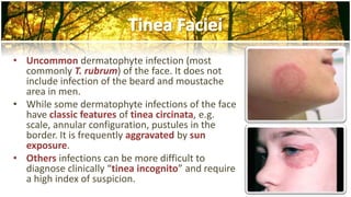 • Uncommon dermatophyte infection (most 
commonly T. rubrum) of the face. It does not 
include infection of the beard and moustache 
area in men. 
• While some dermatophyte infections of the face 
have classic features of tinea circinata, e.g. 
scale, annular configuration, pustules in the 
border. It is frequently aggravated by sun 
exposure. 
• Others infections can be more difficult to 
diagnose clinically “tinea incognito” and require 
a high index of suspicion. 
 
