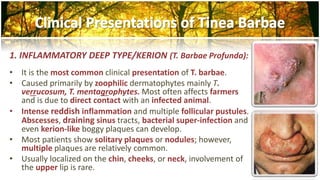1. INFLAMMATORY DEEP TYPE/KERION (T. Barbae Profunda): 
• It is the most common clinical presentation of T. barbae. 
• Caused primarily by zoophilic dermatophytes mainly T. 
verrucosum, T. mentagrophytes. Most often affects farmers 
and is due to direct contact with an infected animal. 
• Intense reddish inflammation and multiple follicular pustules. 
Abscesses, draining sinus tracts, bacterial super-infection and 
even kerion-like boggy plaques can develop. 
• Most patients show solitary plaques or nodules; however, 
multiple plaques are relatively common. 
• Usually localized on the chin, cheeks, or neck, involvement of 
the upper lip is rare. 
 