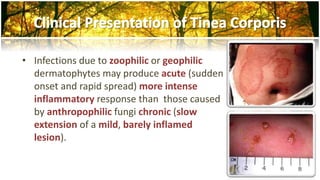 • Infections due to zoophilic or geophilic 
dermatophytes may produce acute (sudden 
onset and rapid spread) more intense 
inflammatory response than those caused 
by anthropophilic fungi chronic (slow 
extension of a mild, barely inflamed 
lesion). 
 
