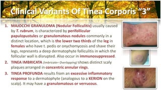 1. MAJOCCHI GRANULOMA (Nodular Folliculitis) usually caused 
by T. rubrum, is characterized by perifollicular 
papulopustules or granulomatous nodules commonly in a 
distinct location, which is the lower two thirds of the leg in 
females who have t. pedis or onychomycosis and shave their 
legs, represents a deep dermatophyte folliculitis in which the 
follicular wall is disrupted. Also occur in immunosuppressed. 
2. TINEA IMBRICATA (Imbricate= Overlapping) shows distinct scaly 
plaques arranged in concentric annular rings. 
3. TINEA PROFUNDA results from an excessive inflammatory 
response to a dermatophyte (analogous to a KERION on the 
scalp). It may have a granulomatous or verrucous. 
 