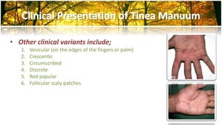 • Other clinical variants include; 
1. Vesicular (on the edges of the fingers or palm) 
2. Crescentic 
3. Circumscribed 
4. Discrete 
5. Red papular 
6. Follicular scaly patches 
 