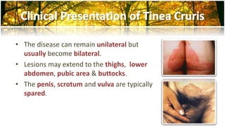 • The disease can remain unilateral but 
usually become bilateral. 
• Lesions may extend to the thighs, lower 
abdomen, pubic area & buttocks. 
• The penis, scrotum and vulva are typically 
spared. 
 