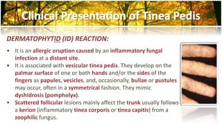 DERMATOPHYTID (ID) REACTION: 
• It is an allergic eruption caused by an inflammatory fungal 
infection at a distant site. 
• It is associated with vesicular tinea pedis. They develop on the 
palmar surface of one or both hands and/or the sides of the 
fingers as papules, vesicles, and, occasionally, bullae or pustules 
may occur, often in a symmetrical fashion. They mimic 
dyshidrosis (pompholyx). 
• Scattered follicular lesions mainly affect the trunk usually follows 
a kerion (inflammatory tinea corporis or tinea capitis) from a 
zoophilic fungus. 
 