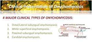 4 MAJOR CLINICAL TYPES OF ONYCHOMYCOSIS: 
1. Distal/Lateral subungual onychomycosis 
2. White superficial onychomycosis 
3. Proximal subungual onychomycosis 
4. Candidal onychomycosis 
 