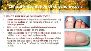 2. WHITE SUPERFICIAL ONYCHOMYCOSIS: 
• Direct penetration into (and usually confinement to) 
the dorsal surface of the nail plate often due to T. 
mentagrophytes. 
• This classic form shows well-delineated discrete 
opaque "white islands" on the plate. 
• Patches coalesce to involve the entire nail plate. The 
nail becomes rough, soft and crumbly. 
• Transverse striate bands and deeper invasion of the 
nail plate can also occur. These variants are more 
likely be caused by T. rubrum or non-dermatophyte 
molds. 
 